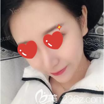 驼峰鼻矫正术后15天肿胀消除 驼峰鼻矫正术后15天肿胀消除