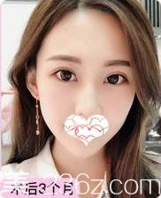 只有做一次眼综合手术才能体会到一双网红大眼的魅力