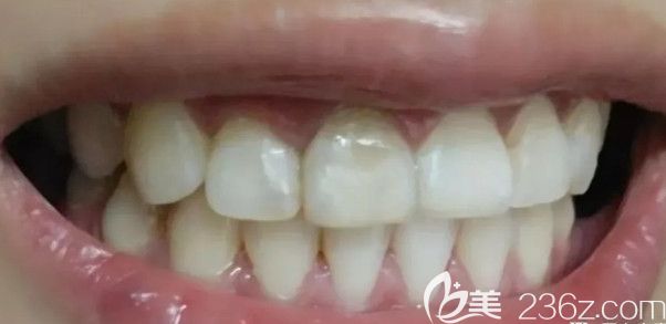 经过一年2个月的时候牙齿终于矫正好了 经过一年2个月的时候牙齿终于矫正好了