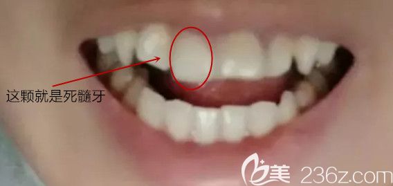 有颗死髓牙,牙列不齐 有颗死髓牙,牙列不齐