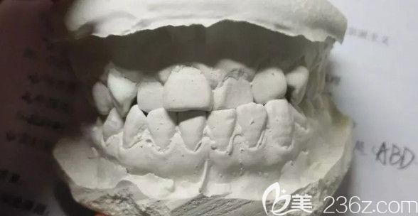 决定矫正后做的牙模 决定矫正后做的牙模