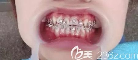 决定矫正时粘的托槽 决定矫正时粘的托槽