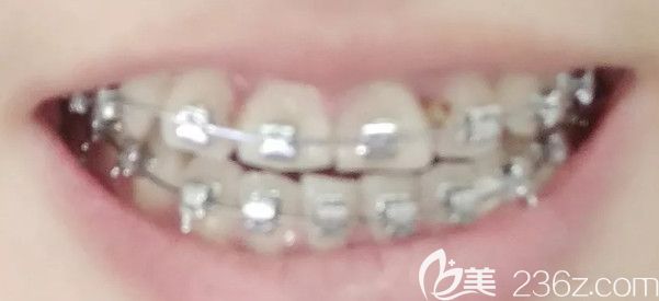 矫正三个月的效果图 矫正三个月的效果图