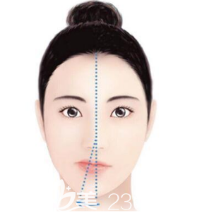 害怕做轮廓手术后脸下垂的妹子们就一定要配合面部提升手术一起做