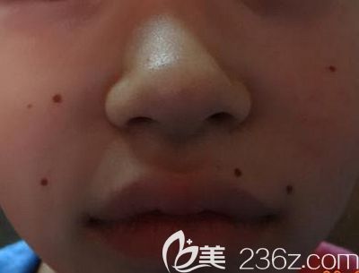 激光可以去除脸上的黑痣