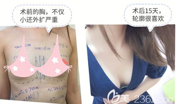 术前的胸不仅小还外扩明显,做了麦格假体隆胸术后 术前的胸不仅小还外扩明显,做了麦格假体隆胸术后