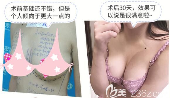 娜绮丽假体隆胸术后30天 娜绮丽假体隆胸术后30天