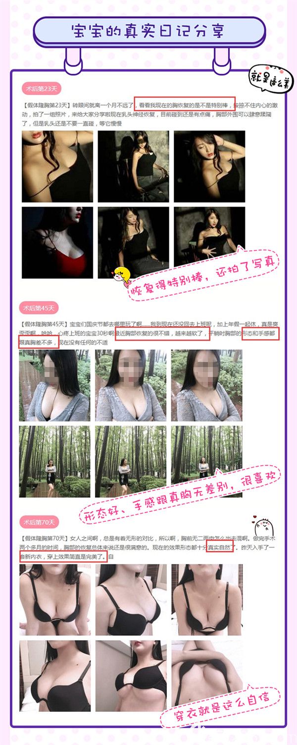 真实的宝宝隆胸术后日记分享反馈 真实的宝宝隆胸术后日记分享反馈