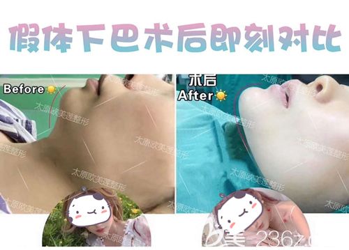 陌陌做硅胶垫下巴术后即刻效果 陌陌做硅胶垫下巴术后即刻效果