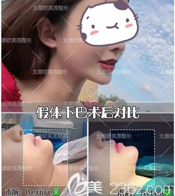 假体垫下巴术后3个月效果真实自然 假体垫下巴术后3个月效果真实自然