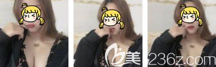 ES假体丰胸术后1个月胸部基本恢复