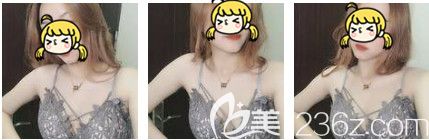 假体隆胸术后15天胸部消肿