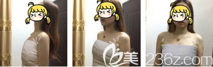 刚做完假体隆胸手术后胸部微肿