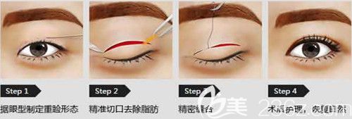 周瑞芳医生做双眼皮手术过程 周瑞芳医生做双眼皮手术过程