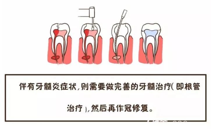 牙隐裂治疗方法