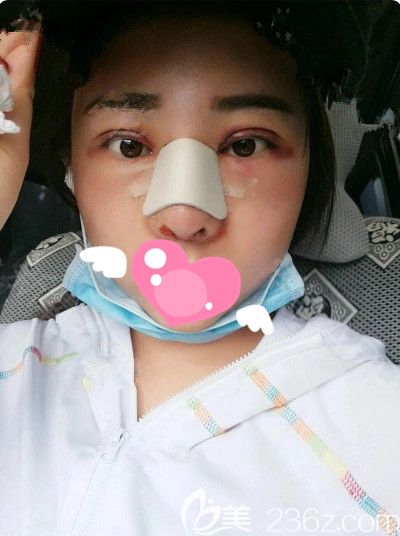 刚做完膨体隆鼻+双眼皮+开内眼角
