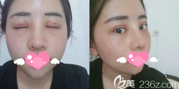 术后一周拆线膨体隆鼻+双眼皮+开内眼角恢复