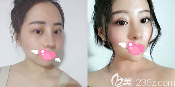 膨体隆鼻+双眼皮+开内眼角半月恢复