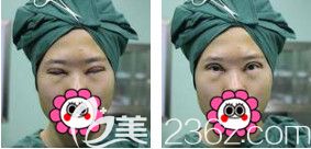 刚做完眼综合术后眼睛红肿