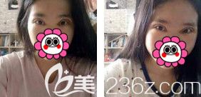 眼综合术后3天眼睛微肿