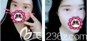 双眼皮+开眼角+上睑提肌术后15天慢慢消肿