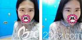 做完眼综合手术1个月双眼皮线条流畅