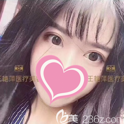 做完双眼皮手术15天