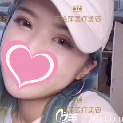 忍不住想分享肿泡眼的我做完全切双眼皮手术40天后恢复自然的照片