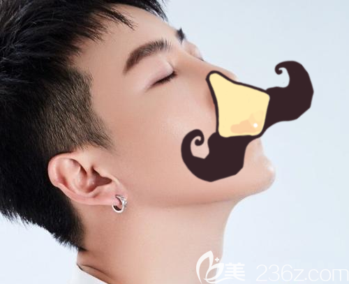 植鬓角之前,我总觉得自己少点阳刚之气 植鬓角之前,我总觉得自己少点阳刚之气