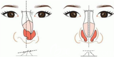 影响隆鼻价格的因素