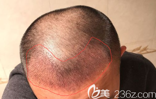 植发2600毛囊单位一周效果 植发2600毛囊单位一周效果