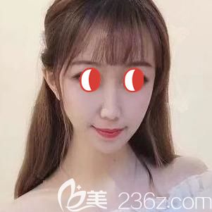 埋线提升术后7天针眼逐渐消失