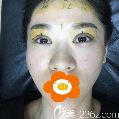 手术前躺在病床上医生为我划线