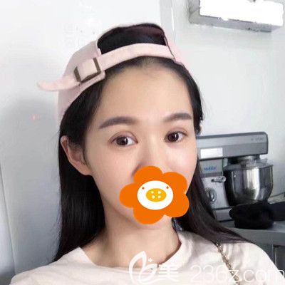 术后一周眼睛还是有点肿