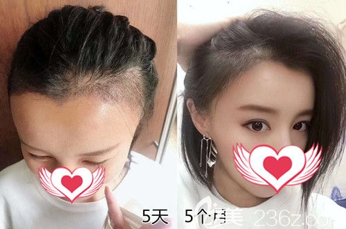 术后5天和5个月的效果对比 术后5天和5个月的效果对比