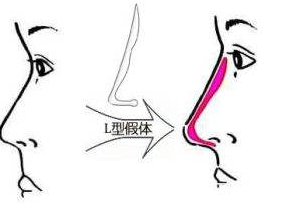 价格便宜隆鼻手术谨慎选择