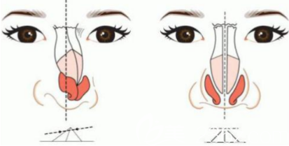 假体隆鼻容易出现的后遗症