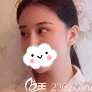 丰太阳穴术后8天有点小肿胀