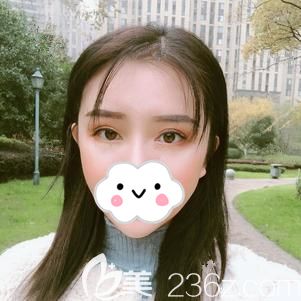 填充太阳穴术后25天护理到位吸收稳定