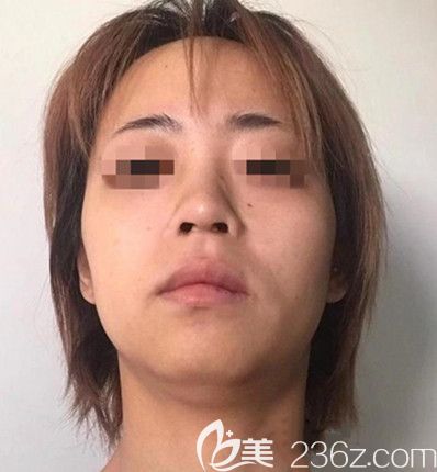 磨骨手术前 磨骨手术前