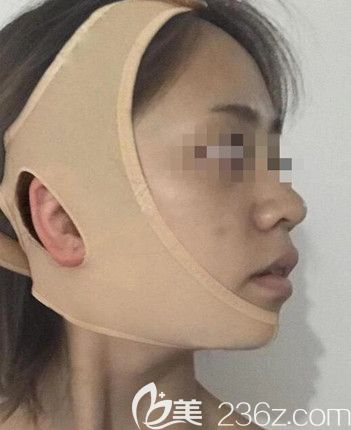 磨骨手术后要坚持戴头套 磨骨手术后要坚持戴头套