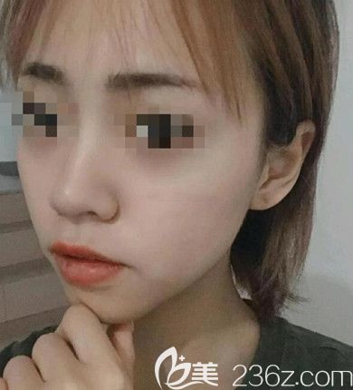 磨骨手术3个月恢复照片 磨骨手术3个月恢复照片