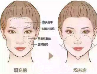 自体脂肪面部填充