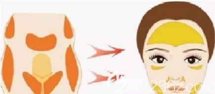 自体脂肪面部填充如何打造幼幼脸