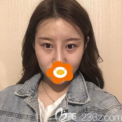 术后17天眼睛有点内双