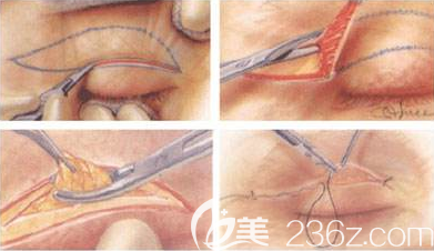 双眼皮手术