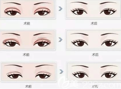 割双眼皮选择季节很重要