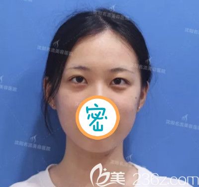 做双眼皮开眼角术前照 做双眼皮开眼角术前照