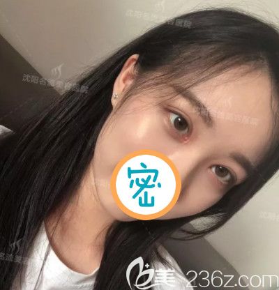 双眼皮开眼角术后恢复好的效果照 双眼皮开眼角术后恢复好的效果照