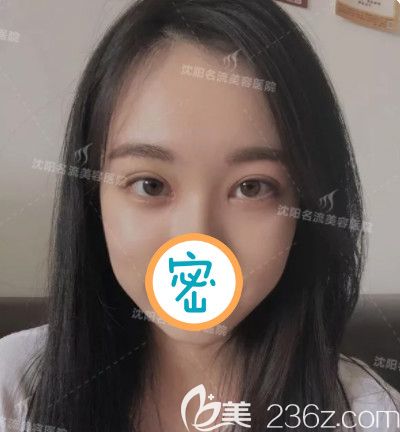 很庆幸当初选择双眼皮和开眼角一起做了，看恢复后水灵灵的大眼睛很撩人哦！